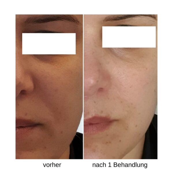 Vorher Nachher SkinCareSystem Gesichtspflege MAYKOSMETIK Aarau 19